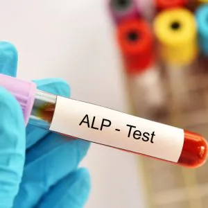 Bilirubina bezpośrednia - badanie laboratoryjne