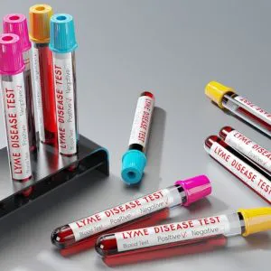 Borelioza IgG - badanie laboratoryjne