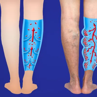 Доплерографія артерій нижніх кінцівок