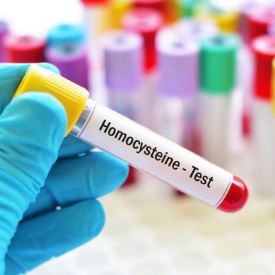 Homocysteina - badanie laboratoryjne