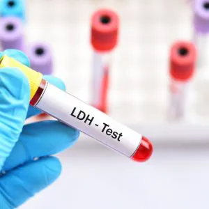 ldh-badanie-laboratoryjne-badamysie LDH - badanie laboratoryjne