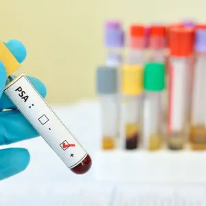 marker-fpsa-badanie-laboratoryjne-badamysie Marker fPSA - badanie laboratoryjne