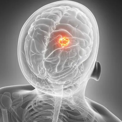 Pituitary MRI without contrast (without CM)