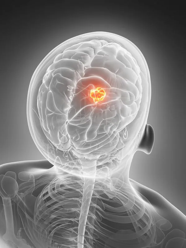 Pituitary MRI without contrast (without CM)