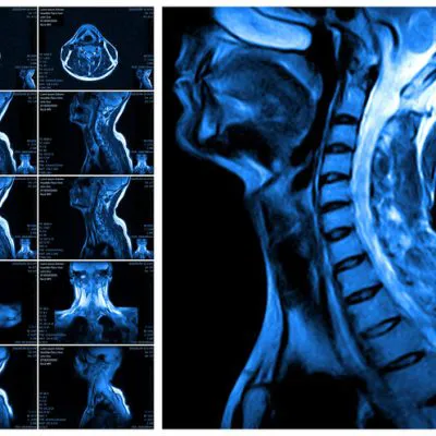 mri-szyi bez kontrastu bez cm