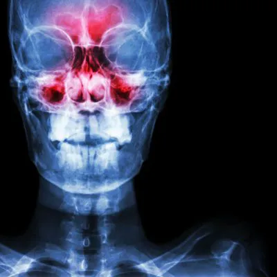 Sinus MRI before and after contrast (CM)