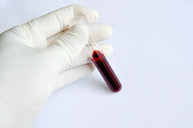 Mumps IGG antibodies (Myxovirus parotitis) – laboratory test