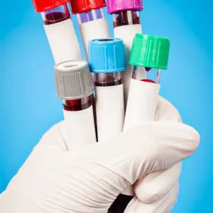 Antinuclear antibodies (ANA – HEP2) – laboratory test