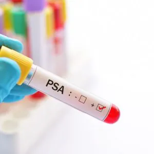 psa-badanie-laboratoryjne-2-badamysie Marker PSA - badanie laboratoryjne