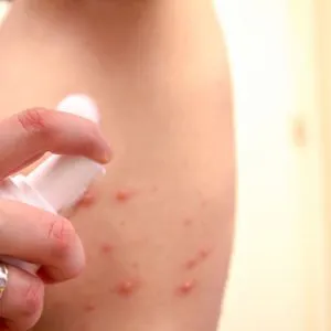 Rubella IGG / RUB G – laboratory test