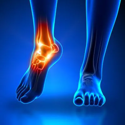Ankle joint X-ray (AP+lateral)