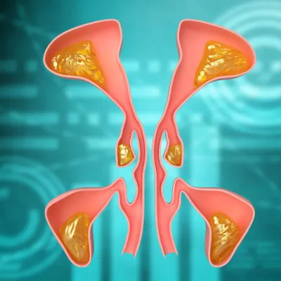 HR computed tomography (TK) of the paranasal sinuses